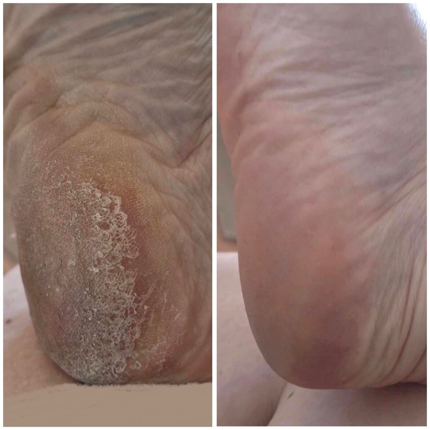 LOVASKIN INSTANT FOOT PEEL Deluxe Kit