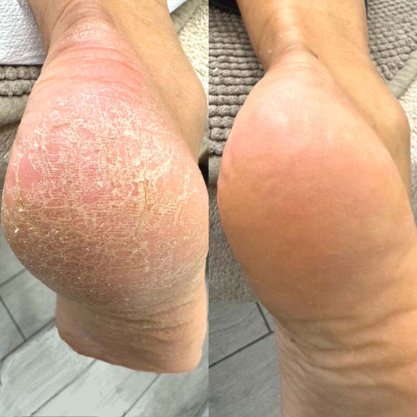 Duo essentiel LOVASKIN INSTANT FOOT PEEL - Peeling instantané des pieds 75 ml avec hydratant instantané 50 ml 